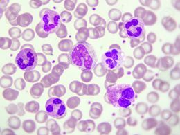 cbc peripheral blood picture